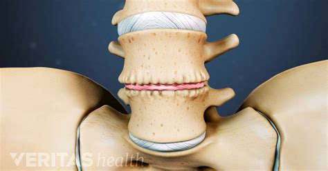 Pain from Degenerative Disc Disease