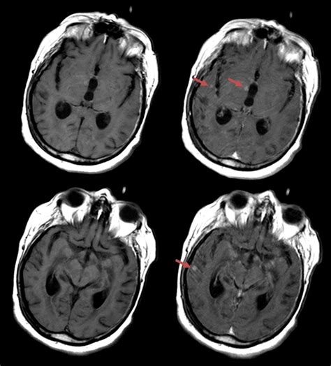 Gadolinium Mri