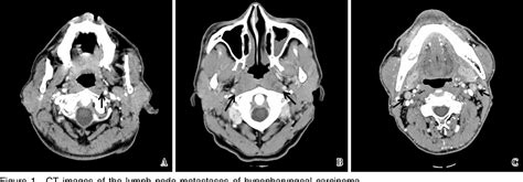 Figure 1 from Analysis of cervical and retropharyngeal lymph node ...