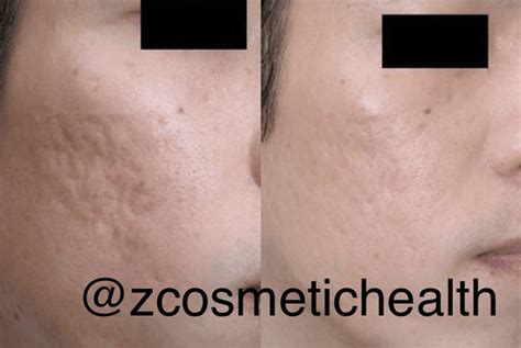 Acne Scar Treatments | Z Cosmetic Health Blog | Sherman Oaks, CA