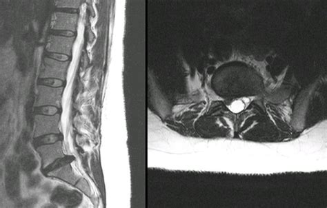 Lumbar Spine Mri Bulging Disc