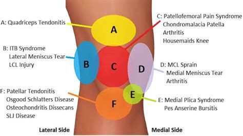 Knee Pain - Muscle Tone