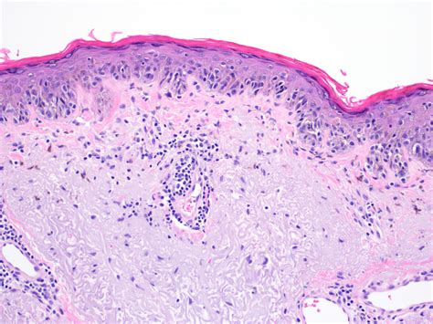 Acral Lentiginous Melanoma Histology