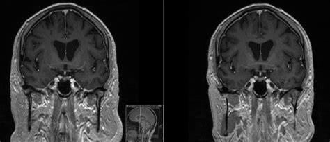 Anterior Commissure