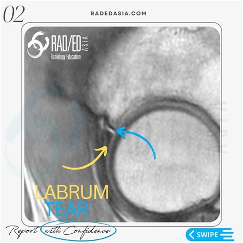 HIP LABRUM LABRAL TEAR MRI RADIOLOGY - Radedasia