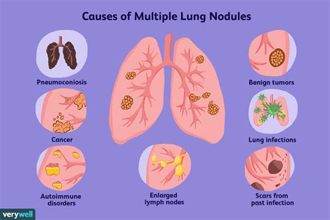 Common Causes of Multiple Lung Nodules