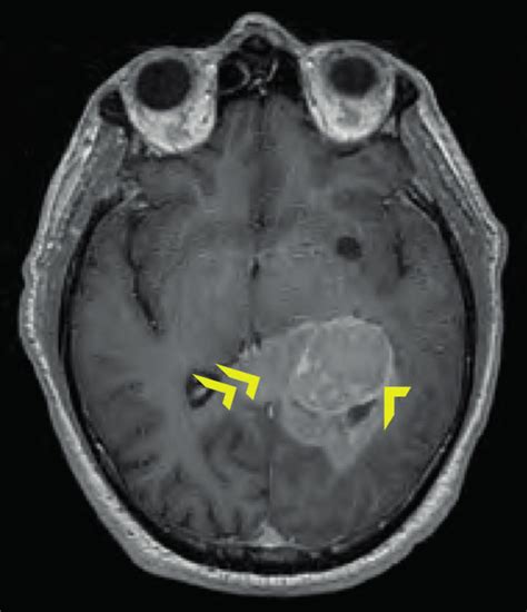 Axial T1-weighted MRI brain with gadolinium contrast administered. A ...