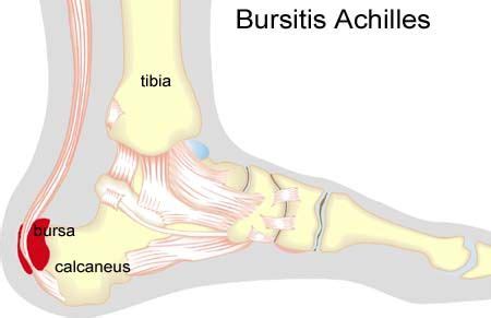 Inflammation of the bursa at the attachment of the Achilles to the heel ...