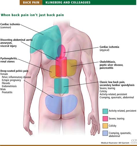 [PDF] Masquerade: medical causes of back pain. | Semantic Scholar