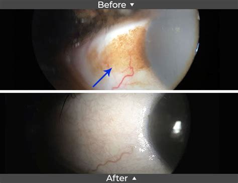 Conjunctival Nevus Removal Before and After Pictures