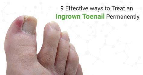 Ingrown Toenail Types, Causes, Symptoms, Diagnosis,, 47% OFF