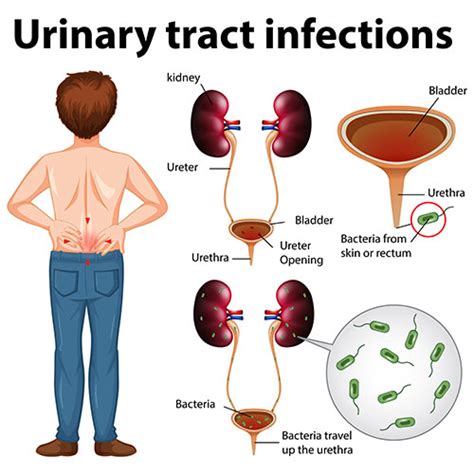 What Causes UTI Infection?