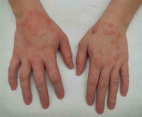 Dermatitis - Wikipedia