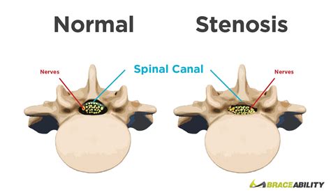 Lumbar Spinal Stenosis | Symptoms, Surgery, Exercises & Treatment