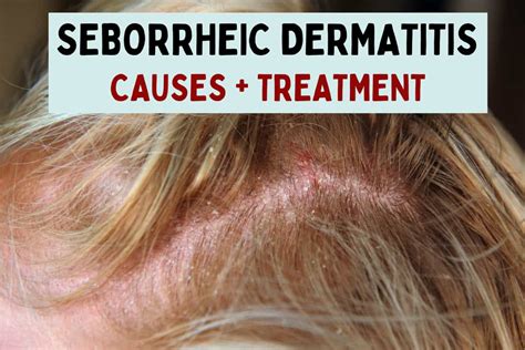 Seborrheic Dermatitis (Dandruff And Cradle Cap) Causes,, 47% OFF