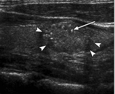 Thyroid Nodules - Causes, Symptoms, Ultrasound, Surgery