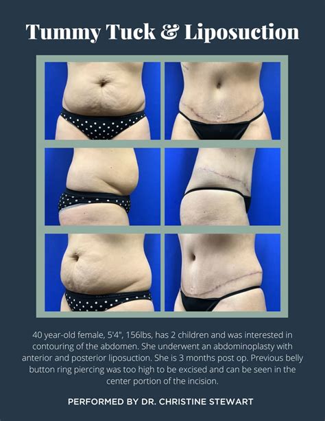 5 Key Differences Between Tummy Tuck & Liposuction Surgery | Edina ...