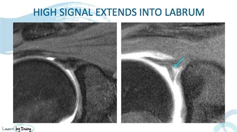 MRI Shoulder SLAP Tears 3 Things to look for - Radedasia