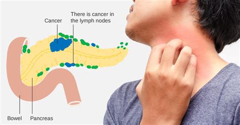 10 Warning Signs of Pancreatic Cancer You Need to Know! - DavidWolfe.com