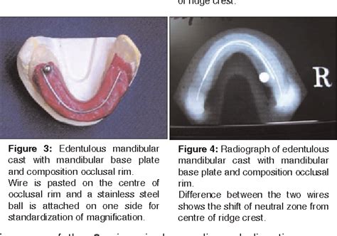 Figure 3 from Relationship of neutral zone and alveolar ridge with ...