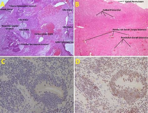 Ovarian Torsion Histology