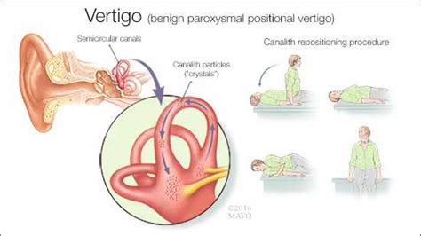 Mayo Clinic Q and A: Dizziness Caused by Inner Ear Crystals - Mayo ...