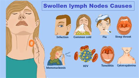 Swollen Lymph Nodes Locations