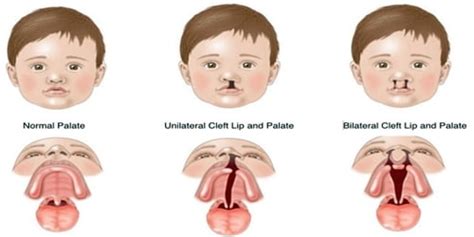 Cleft Lip and Cleft Palate (Cause, Symptoms, and Complications ...