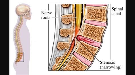 Lumbar Spinal Stenosis Cauda Equina Syndrome Sciatica