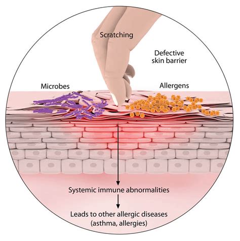 atopic dermatitis cause - pictures, photos