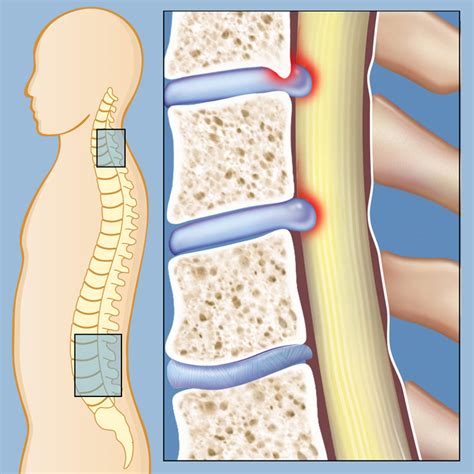 Lumbar Spinal Stenosis