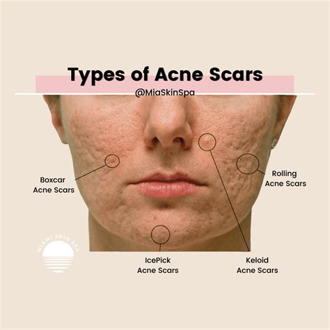 Types of Acne Scars: Pictures, Diagnosis and Treatments