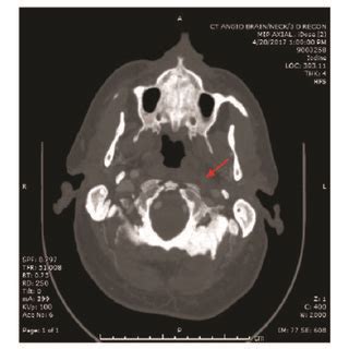 CT angiogram head and neck. Note the occlusion of the left internal ...