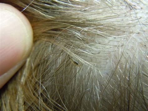 How to Identify Lice & Nits (Lice Eggs) - Lice Charmers