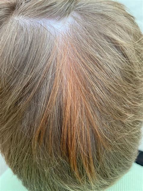 Congenital red hair heterochromia in the background of blond scalp hair ...