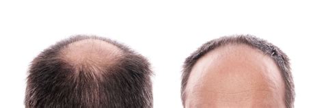 Receding Hairline: Stages, Causes, Prevention & Treatments