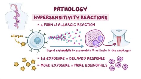 Eosinophilic Esophagitis Symptoms, Causes, Treatment NORD, 54% OFF