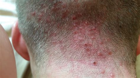 Scalp Folliculitis Hair Loss regarding Desire