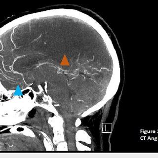 CT angiogram of the head. The blue triangle arrow shows normal blood ...