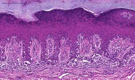 Acral lentiginous melanoma, “in situ” pattern, detail that points ...