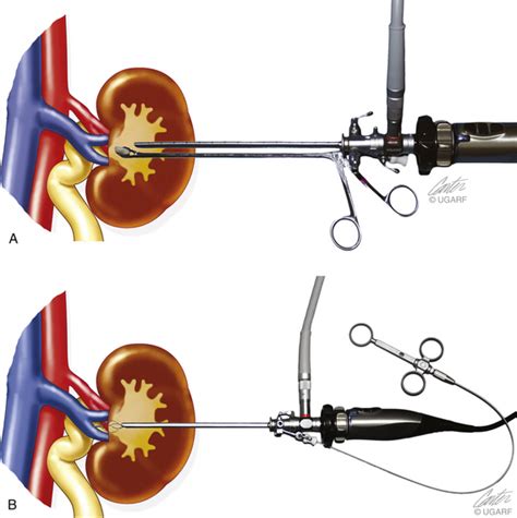 Male cystoscopy recovery time. Male Cystoscopy Recovery: Timeline, Tips ...