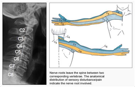 Cervical Radicular Pain | e-algos