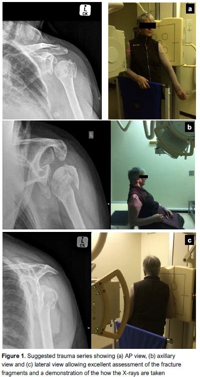 Proximal Humerus Fracture Presentation