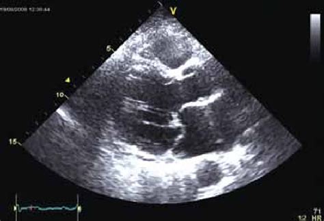 Mitral Valve Prolapse Echocardiography | Images and Photos finder