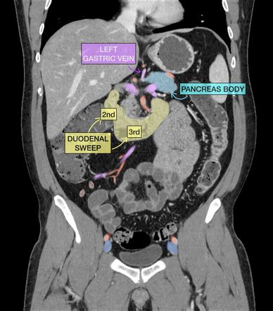 How to read a CT of the abdomen and pelvis | Radiology Case ...