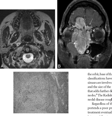 Figure 2 from Retropharyngeal Lymph Node Metastasis From ...