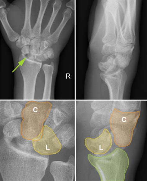 Perilunate dislocation - Radiology at St. Vincent's University Hospital