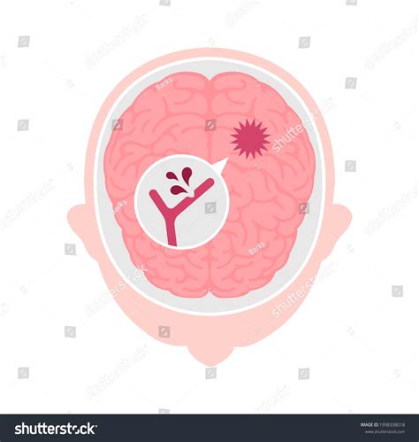 Types Human Brain Stroke Vector Illustration Stock Vector (Royalty Free ...