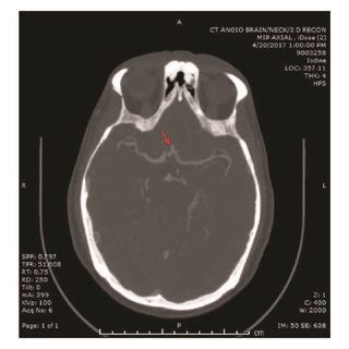 CT angiogram head and neck. Note the occlusion of the left internal ...