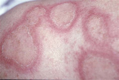 Chronic Cutaneous Lupus Erythematosus